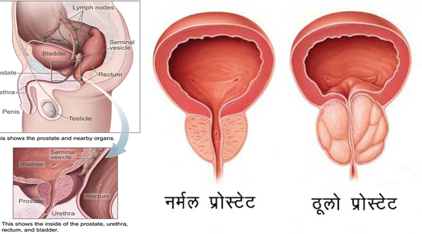 पुरुषलाई प्रोस्टेट बढ्नुका कारण